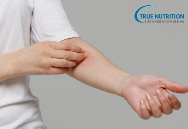 Giang Mai: Bệnh Lây Truyền Qua Đường Tình Dục Cần Cảnh Giác