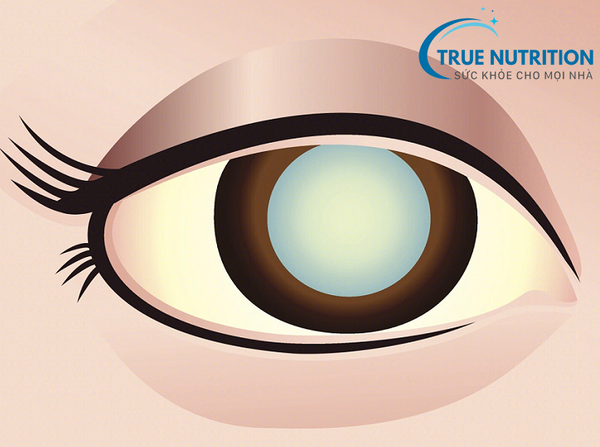 Tiểu Đường và Đục Thủy Tinh Thể