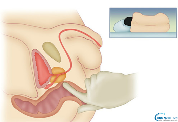 Chữa Bệnh Viêm Tuyến Tiền Liệt: Những Bí Quyết Điều Trị Bền Vững