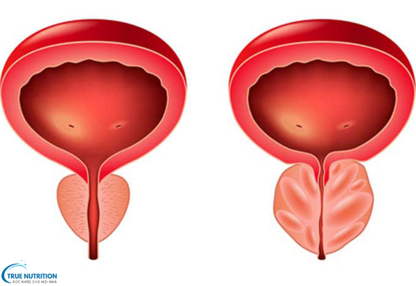Chữa Bệnh Viêm Tuyến Tiền Liệt: Những Bí Quyết Điều Trị Bền Vững