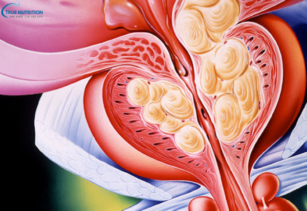 Chữa Bệnh Viêm Tuyến Tiền Liệt: Những Bí Quyết Điều Trị Bền Vững