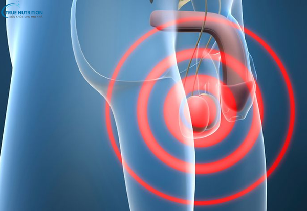 Chữa Bệnh Viêm Tuyến Tiền Liệt: Những Bí Quyết Điều Trị Bền Vững