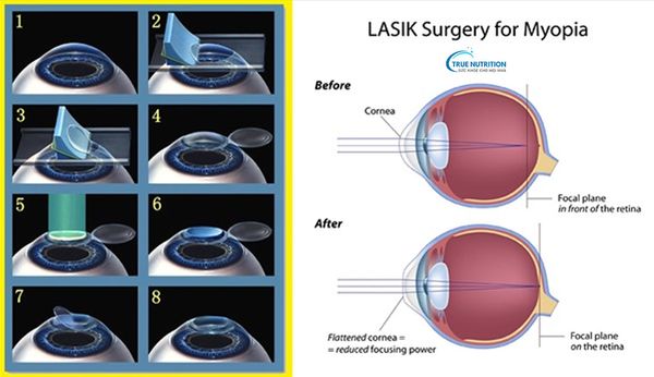 Tác Hại Của Việc Mổ Mắt Cận Thị: Những Điều Cần Biết Trước Khi Quyết Định Phẫu Thuật