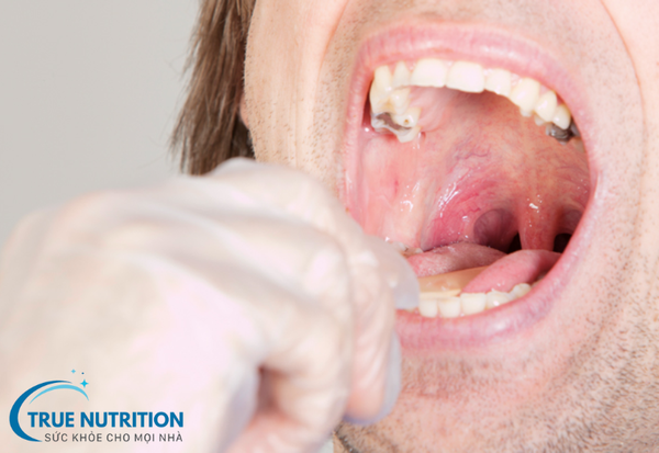 Viêm VA: Nguyên nhân, biểu hiện, biến chứng và cách điều trị