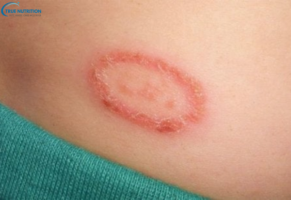 Dấu Hiệu Bệnh Hắc Lào Cần Lưu Ý: Đừng Bỏ Qua Những Triệu Chứng Cảnh Báo