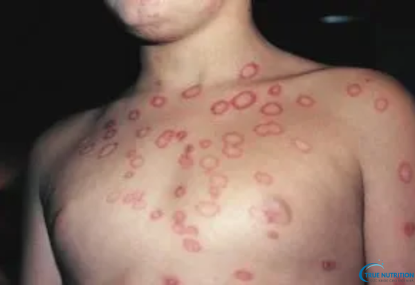 Dấu Hiệu Bệnh Hắc Lào Cần Lưu Ý: Đừng Bỏ Qua Những Triệu Chứng Cảnh Báo