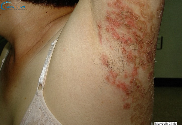 Dấu Hiệu Bệnh Hắc Lào Cần Lưu Ý: Đừng Bỏ Qua Những Triệu Chứng Cảnh Báo