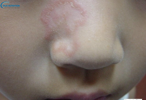 Dấu Hiệu Bệnh Hắc Lào Cần Lưu Ý: Đừng Bỏ Qua Những Triệu Chứng Cảnh Báo