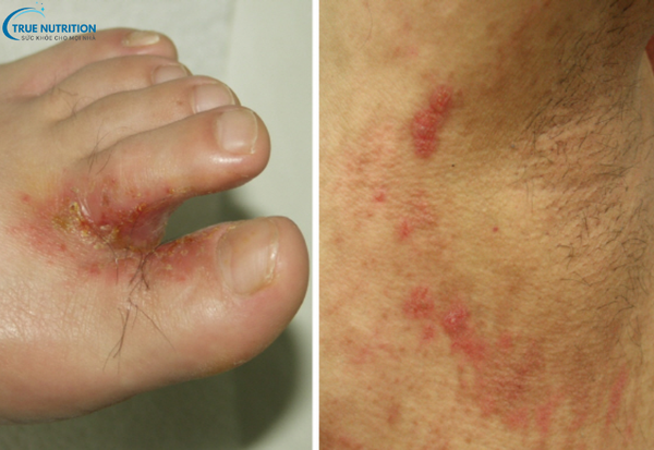 Dấu Hiệu Bệnh Hắc Lào Cần Lưu Ý: Đừng Bỏ Qua Những Triệu Chứng Cảnh Báo