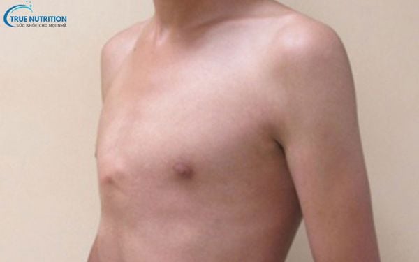 Hình Ảnh Trẻ Bị Nhô Xương Ức Gà: Nguyên Nhân & Phương Pháp Điều Trị