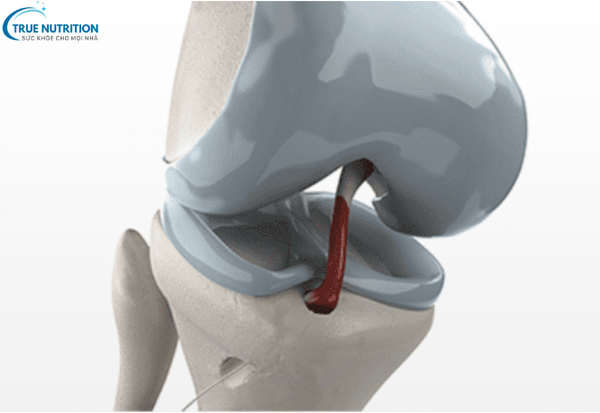 Ghép Dây Chằng: Giải Pháp Hiệu Quả Để Khôi Phục Chức Năng Khớp Gối