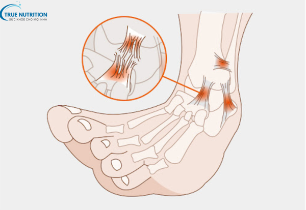 Ghép Dây Chằng: Giải Pháp Hiệu Quả Để Khôi Phục Chức Năng Khớp Gối