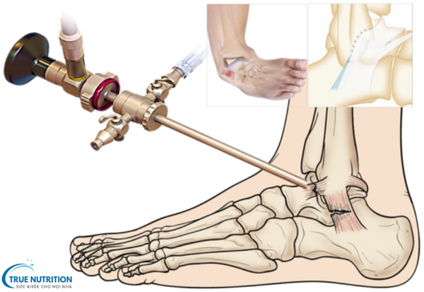 Ghép Dây Chằng: Giải Pháp Hiệu Quả Để Khôi Phục Chức Năng Khớp Gối