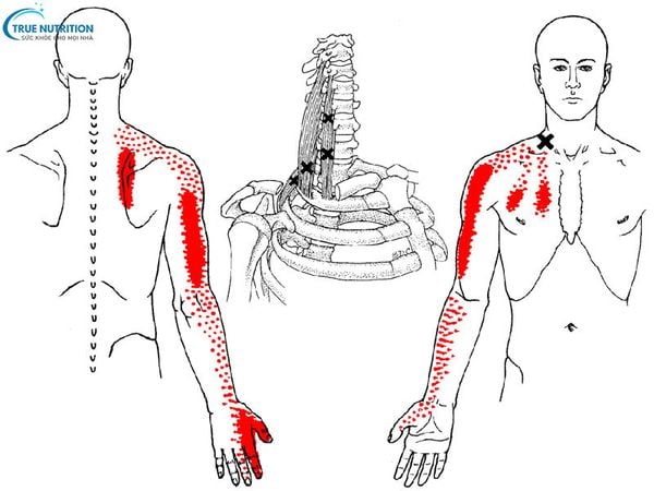 Trigger Point Là Gì? Nguyên Nhân & Liệu Pháp Điều Trị