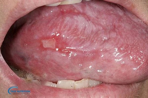 Lớp Màng Nhầy Màu Trắng Bên Trong Miệng Nguyên Nhân, Triệu Chứng và Cách Xử Lý