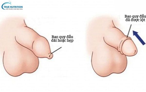 Nhận Diện Hình Ảnh Hẹp Bao Quy Đầu Ở Trẻ Sơ Sinh