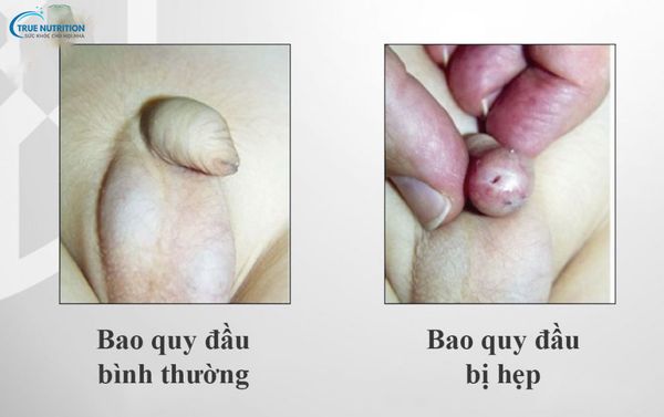 Nhận Diện Hình Ảnh Hẹp Bao Quy Đầu Ở Trẻ Sơ Sinh