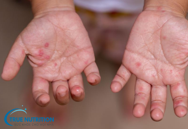 Bệnh Tay Chân Miệng: Cách Nhận Biết Và Phòng Tránh Hiệu Quả