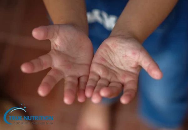 Bệnh Tay Chân Miệng: Cách Nhận Biết Và Phòng Tránh Hiệu Quả