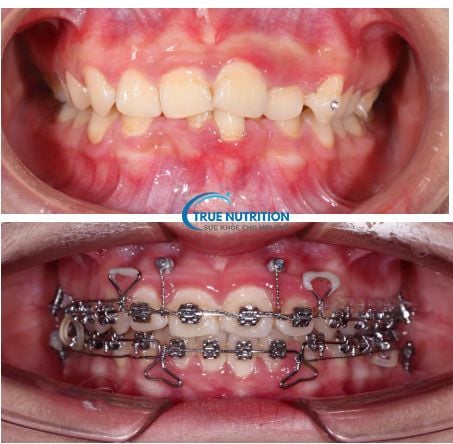 Minivis Chỉnh Nha, Giá, Tác Dụng, Lưu Ý, Thời Gian
