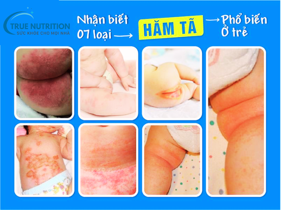 Chữa hăm tã cho trẻ sơ sinh