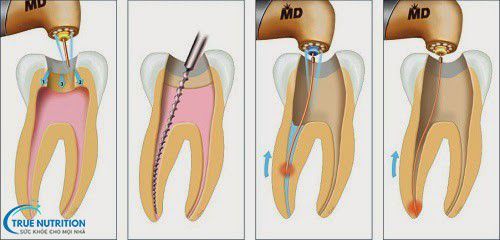 Triệu Chứng Sau Khi Lấy Tủy Răng: Phân Biệt Bình Thường Và Bất Thường