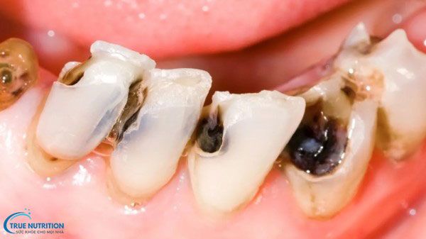 Triệu Chứng Sau Khi Lấy Tủy Răng: Phân Biệt Bình Thường Và Bất Thường