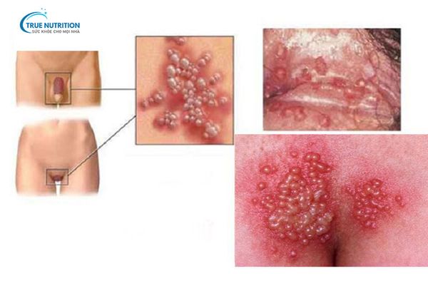 Hình Ảnh Mụn Rộp Sinh Dục Nhận Biết Sớm và Phòng Ngừa Hiệu Quả