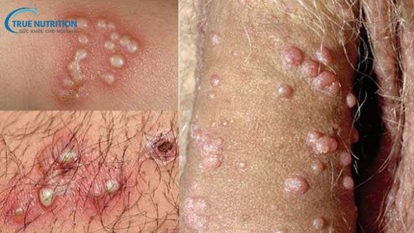 Hình Ảnh Mụn Rộp Sinh Dục Nhận Biết Sớm và Phòng Ngừa Hiệu Quả