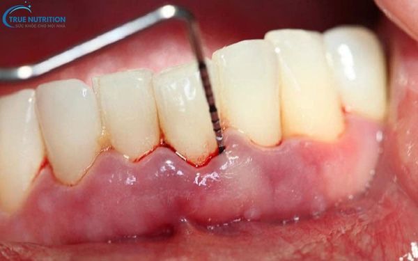 Hình Ảnh Viêm Nướu Răng: Nhận Biết, Điều Trị và Phòng Ngừa