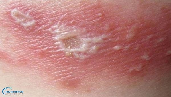 Hình Ảnh Viêm Da Mủ Ở Trẻ Em: Nhận Biết, Điều Trị và Phòng Ngừa