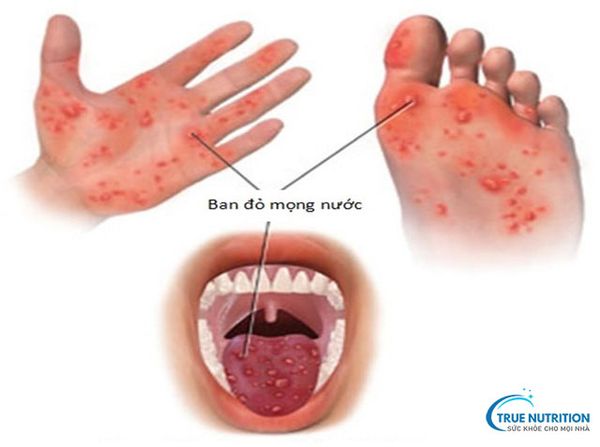 Cách Nhận Diện Hình Ảnh Trẻ Bị Chân Tay Miệng: Dấu Hiệu và Điều Trị