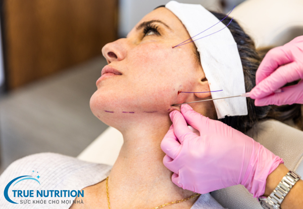 Căng Chỉ Da Mặt: Phương Pháp Trẻ Hóa Da Hiệu Quả Và Tiện Lợi