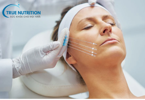 Căng Chỉ Da Mặt: Phương Pháp Trẻ Hóa Da Hiệu Quả Và Tiện Lợi