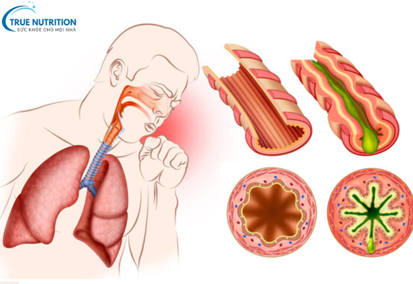 Bệnh Hen Suyễn: Cách Nhận Biết, Phòng Ngừa và Kiểm Soát Để Sống Khỏe