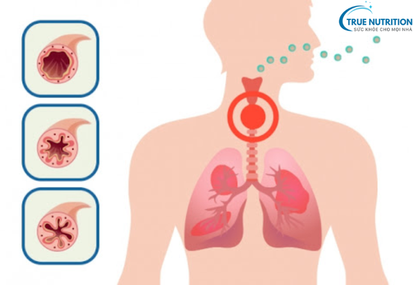 Bệnh Hen Suyễn: Cách Nhận Biết, Phòng Ngừa và Kiểm Soát Để Sống Khỏe