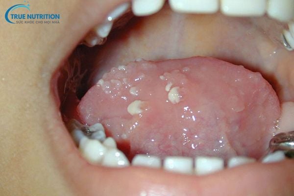 Lưỡi Nổi Mụn Thịt Nguy Hiểm Không? Nguyên Nhân, Bệnh Lý?