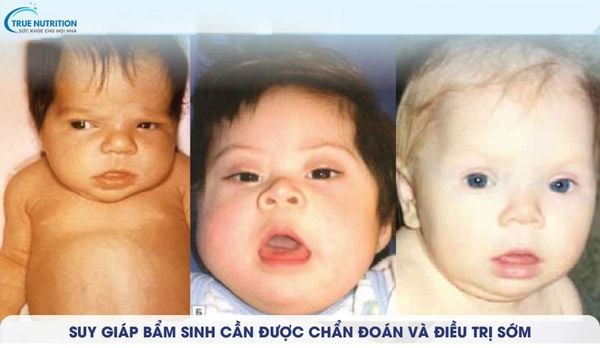 Nhận Diện Hình Ảnh Trẻ Bị Suy Giáp Bẩm Sinh