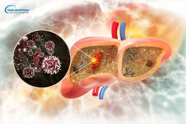 Xơ hóa gan và xơ gan liệu có giống nhau không?