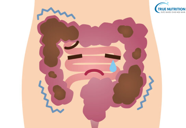 Hội Chứng Ruột Kích Thích: Những Điều&nbsp; Cần Biết Để Bảo Vệ&nbsp; Đường Ruột