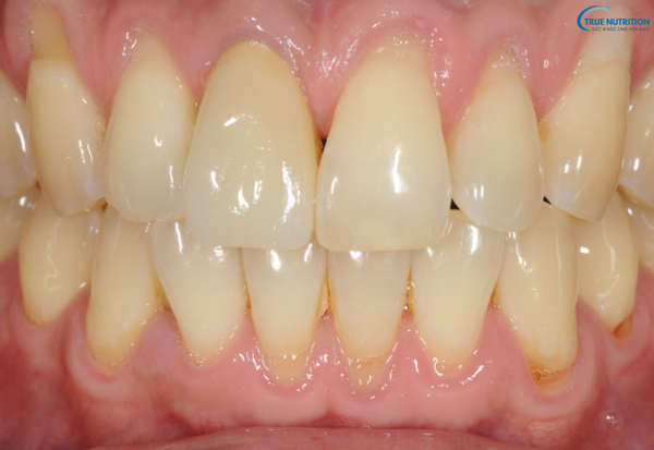 Nguyên Nhân Mòn Cổ Răng: Những Thói Quen Hằng Ngày Bạn Cần Thay Đổi