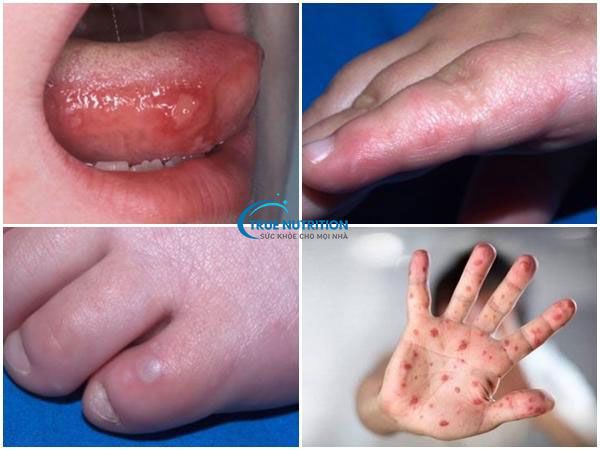 Cách Nhận Diện Hình Ảnh Trẻ Bị Chân Tay Miệng: Dấu Hiệu và Điều Trị