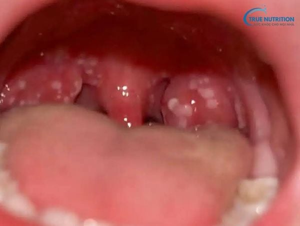 Miệng Bị Nổi Mụn Nước Là Do Đâu? Cách Xử Lý