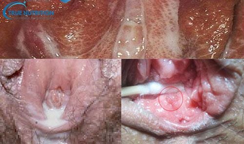 Nhận Diện Hình Ảnh Bệnh Lậu Giai Đoạn Đầu. Khác Biệt Giữa Nam & Nữ