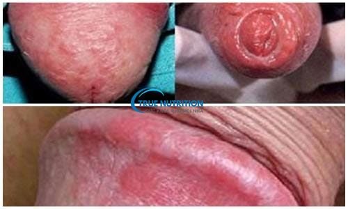 Nhận Diện Hình Ảnh Bệnh Lậu Giai Đoạn Đầu. Khác Biệt Giữa Nam & Nữ