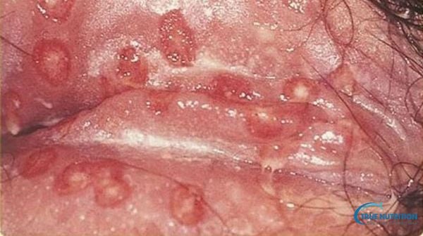 Nhận Diện Hình Ảnh Bệnh Lậu Giai Đoạn Đầu. Khác Biệt Giữa Nam & Nữ