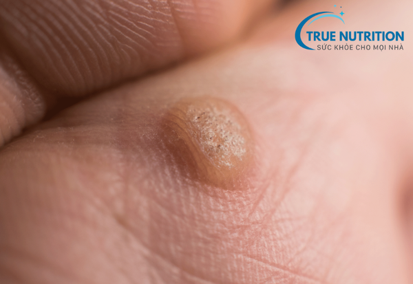 Mụn Cóc: Những Điều Bạn Cần Biết Về Nguyên Nhân và Cách Điều Trị