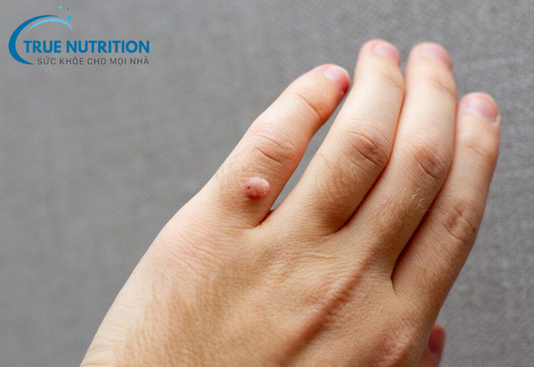 Mụn Cóc: Những Điều Bạn Cần Biết Về Nguyên Nhân và Cách Điều Trị