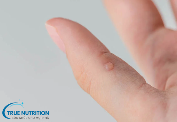 Mụn Cóc: Những Điều Bạn Cần Biết Về Nguyên Nhân và Cách Điều Trị