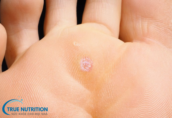 Mụn Cóc: Những Điều Bạn Cần Biết Về Nguyên Nhân và Cách Điều Trị